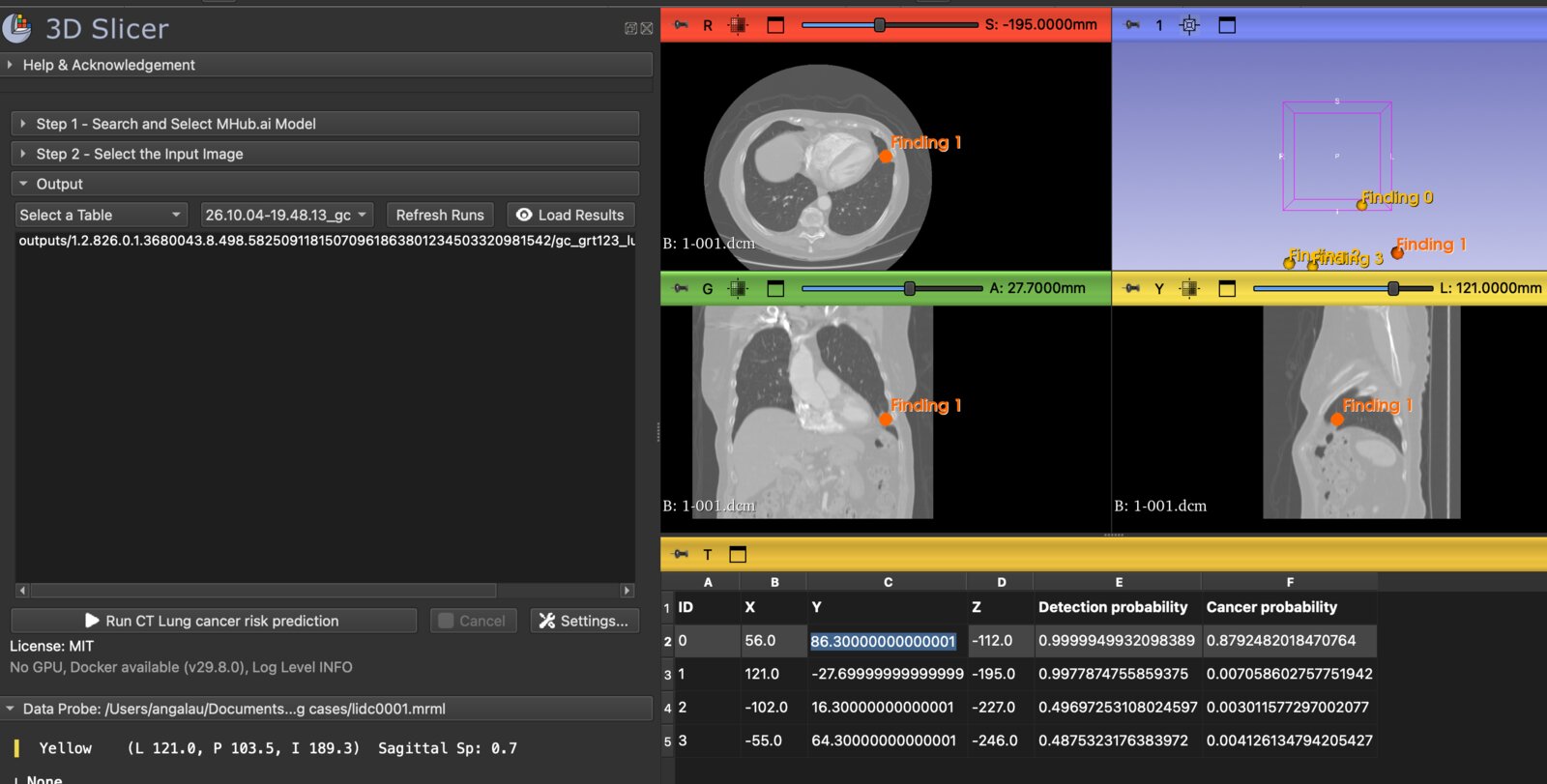 3D Slicer corriendo el modelo de riesgo de cáncer pulmonar de MHub sobre una TC de tórax