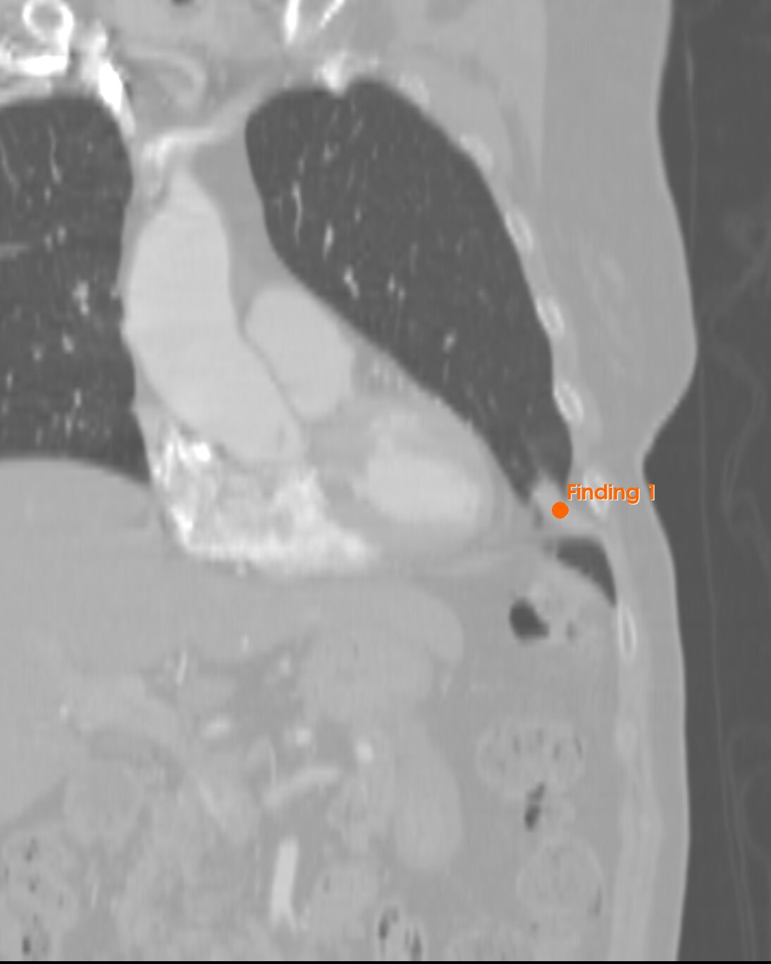 TC de tórax, reconstrucción coronal, con el hallazgo 1 marcado en la base pulmonar